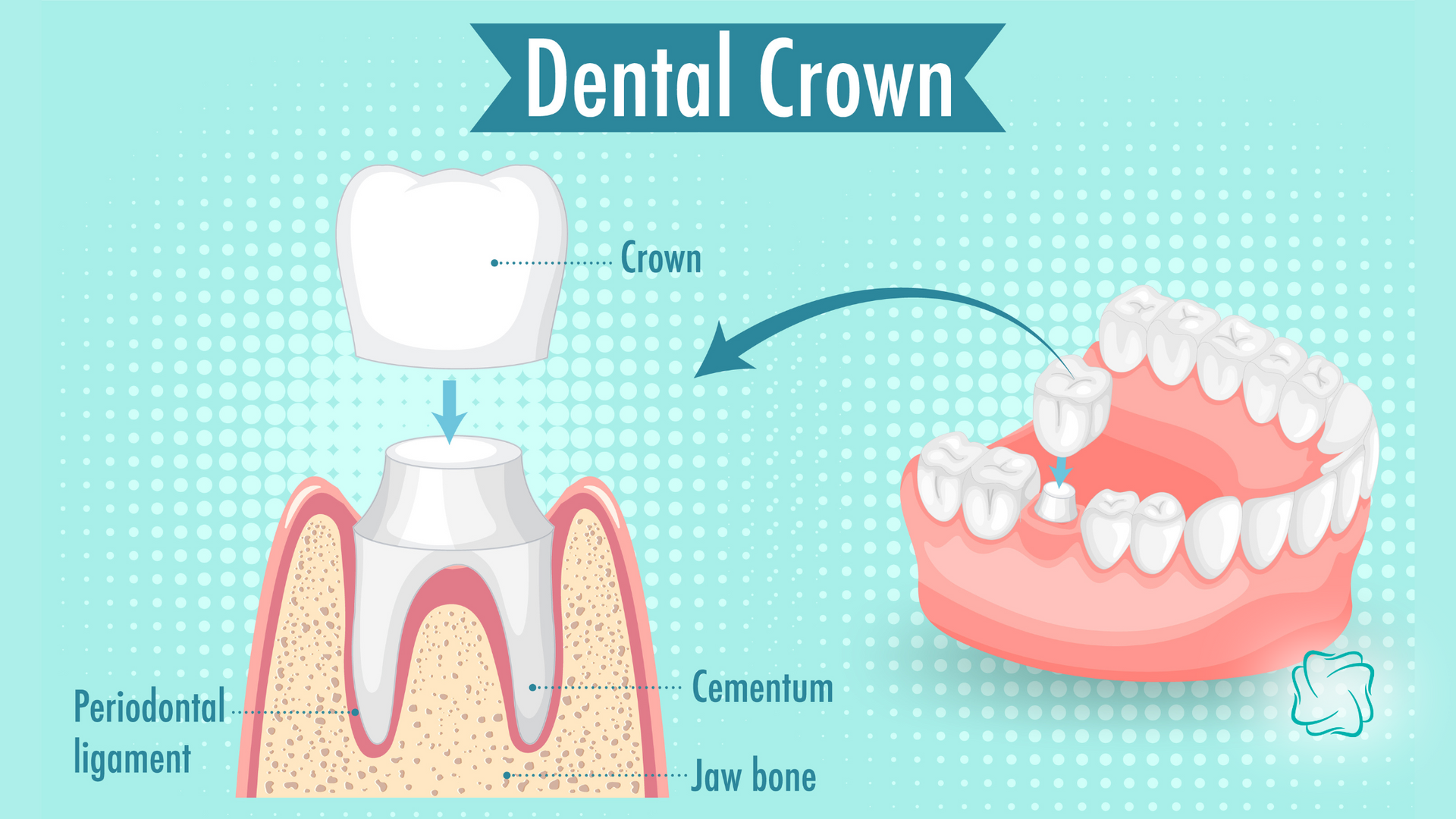 Diagram of dental crown placement on tooth and in the mouth; shows parts, including bone and gum.