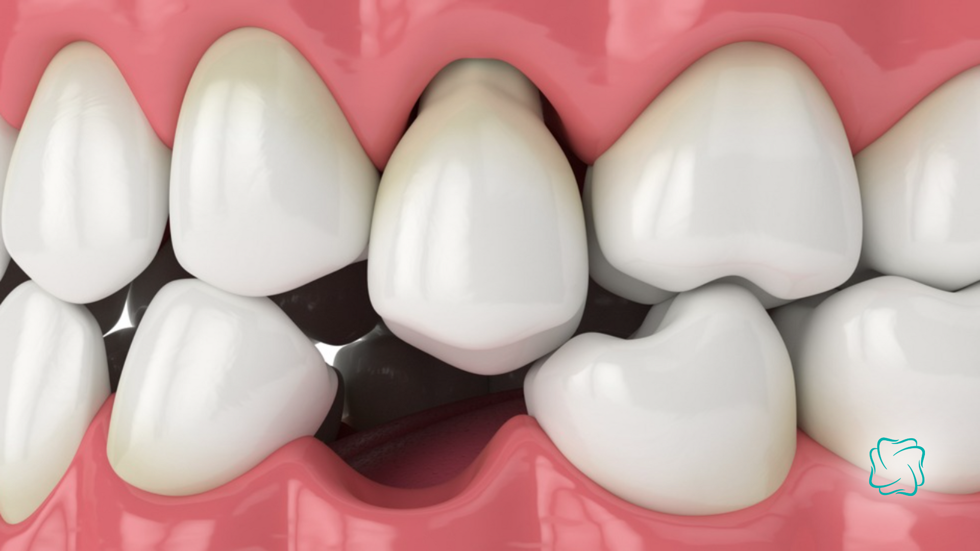 Close-up of teeth and gums, showing a gap between teeth.