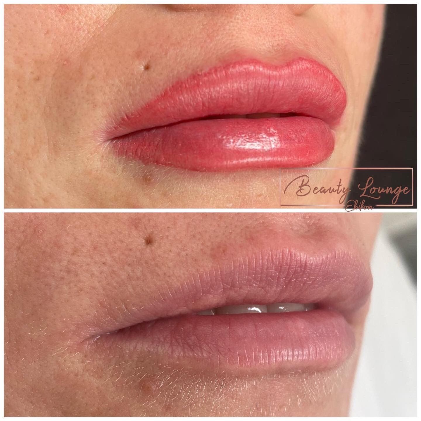 Ein Vorher-Nachher-Bild der Lippen einer Frau.