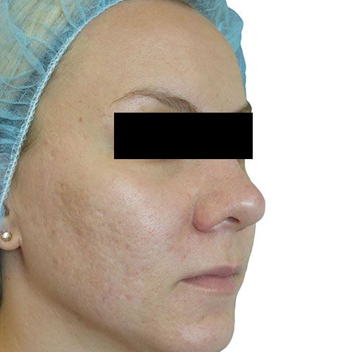Venus Viva MD skin resurfacing after treatment