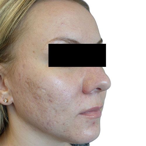 Venus Viva MD skin resurfacing before treatment