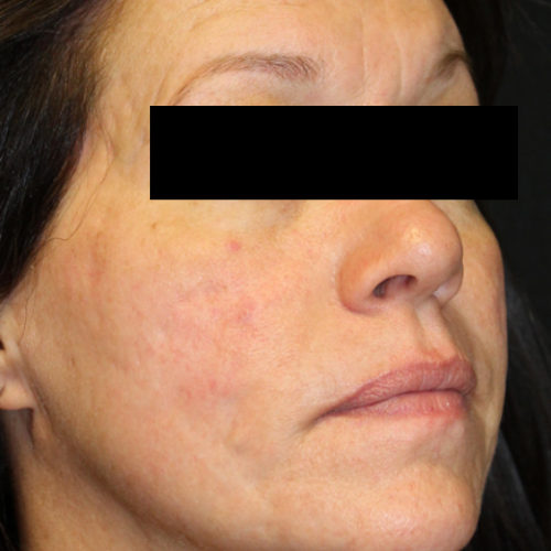 Venus Viva MD acne scar reduction after treatment