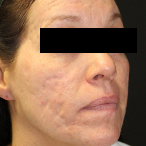 Venus Viva MD acne scar reduction before treatment