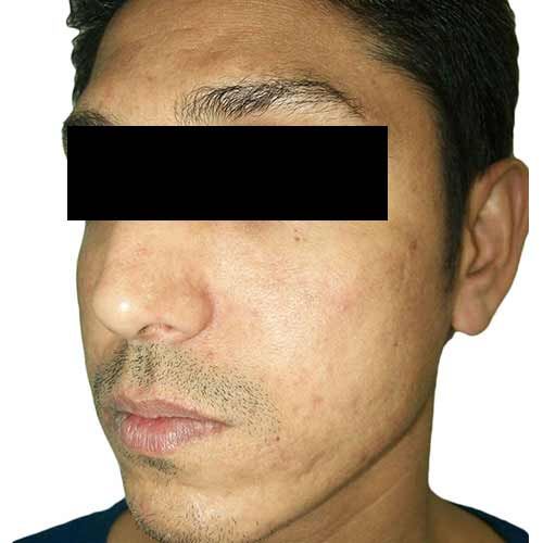 Acne scar reduction after treatment