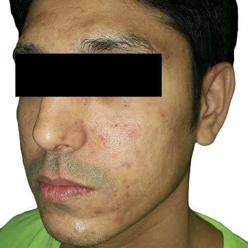 Acne scar reduction before treatment