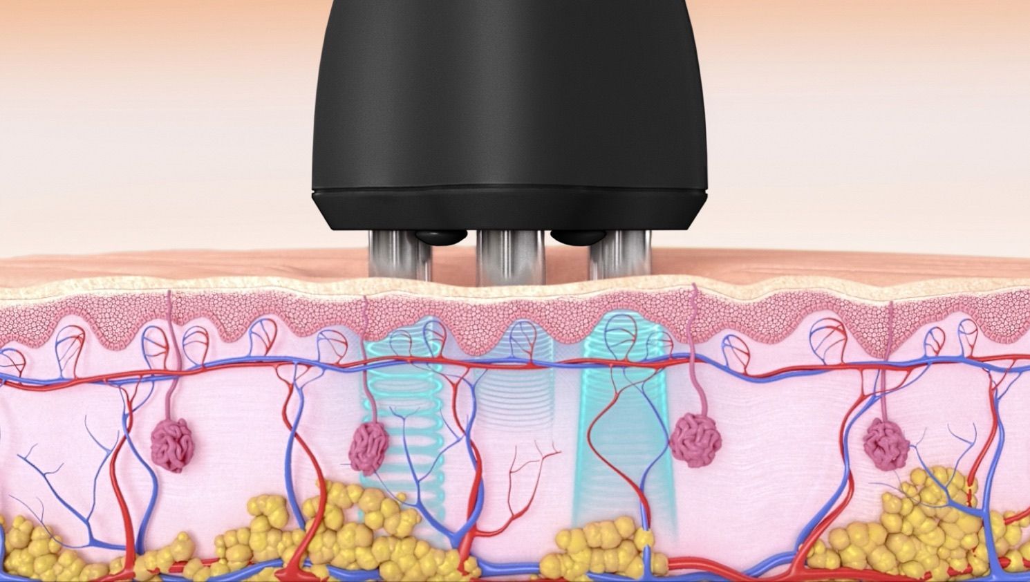 Wrinkle Reduction treatment