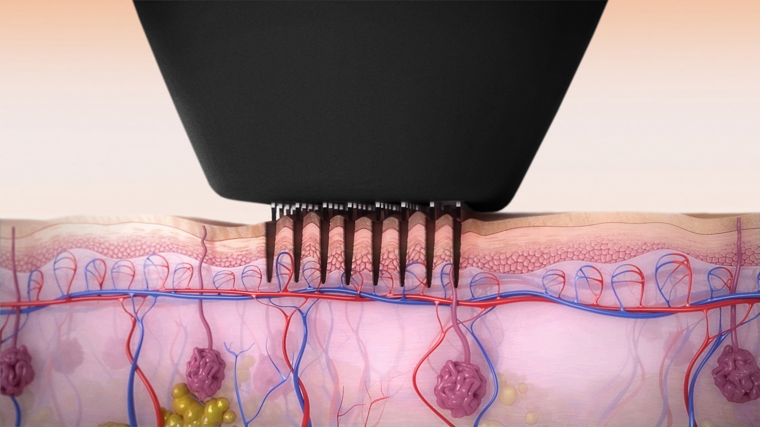 Skin Resurfacing treatment