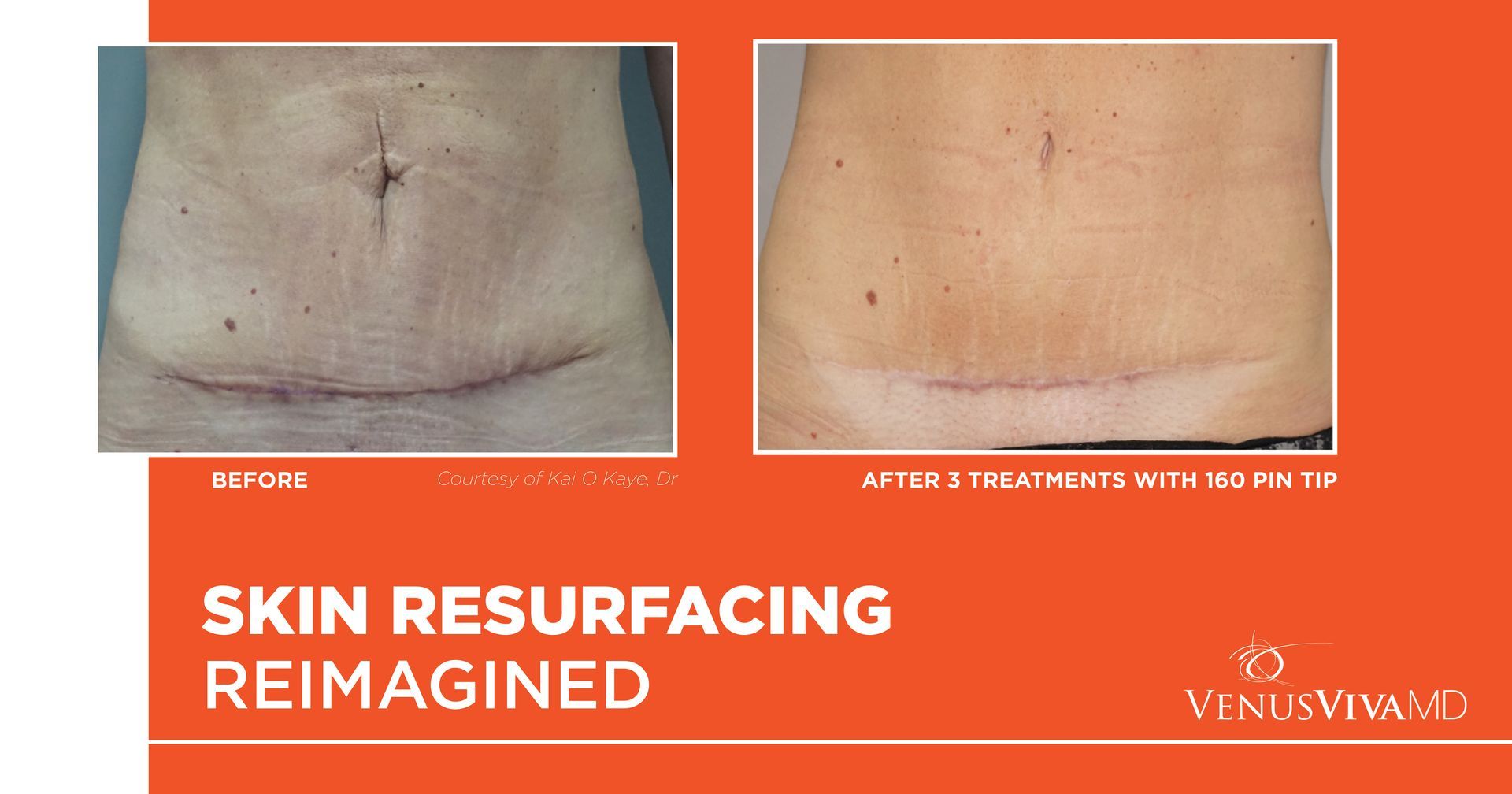 A before and after picture of a woman 's stomach with a scar.
