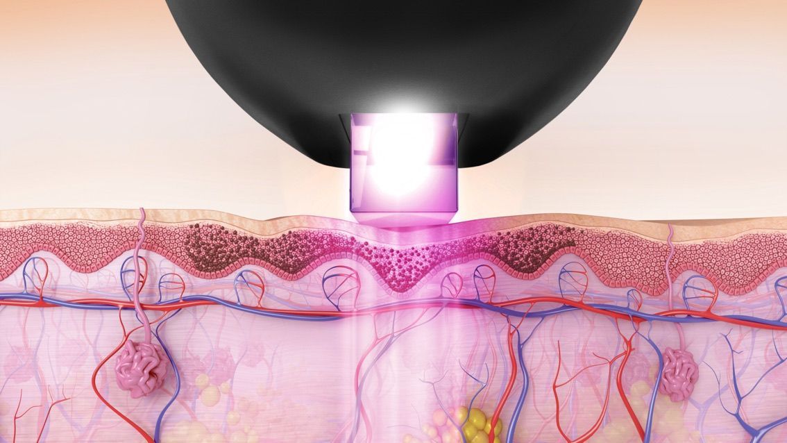 Photorejuvenation treatment