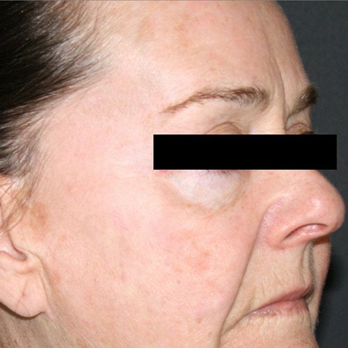 TriBella skin rejuvenation after treatment
