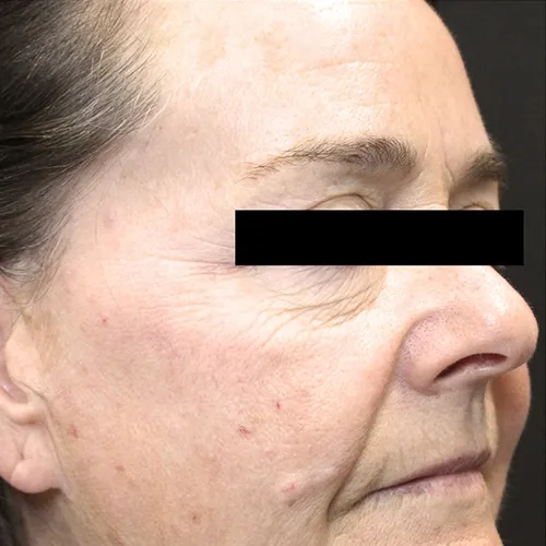 TriBella skin rejuvenation before treatment