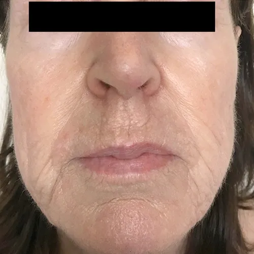 TriBella skin rejuvenation after treatment