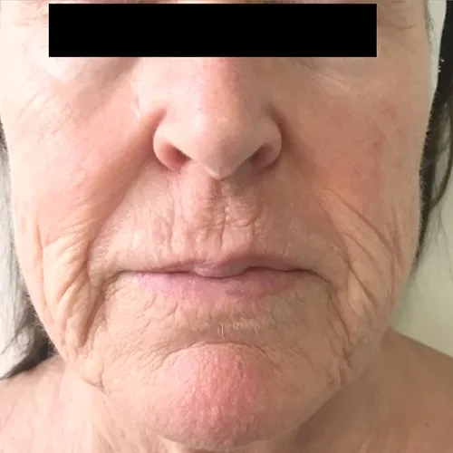 TriBella skin rejuvenation before treatment