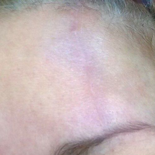 Venus Viva MD scar revision after treatment