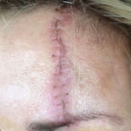 Venus Viva MD scar revision before treatment