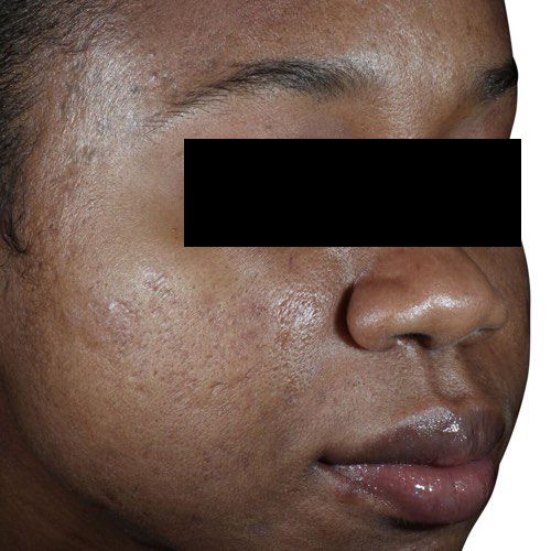 Venus Viva MD acne scarring after treatment