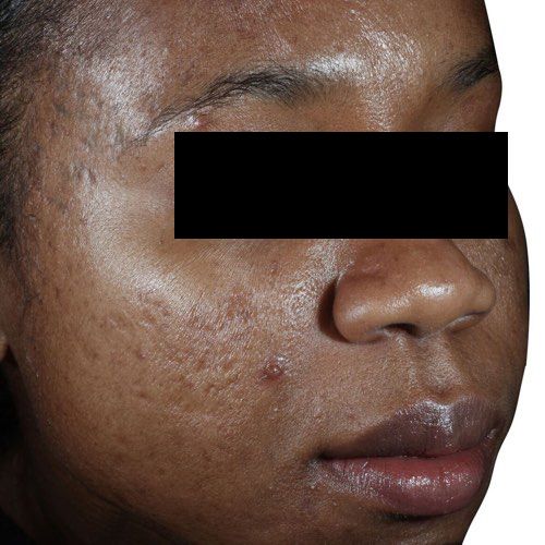 Venus Viva MD acne scarring before treatment