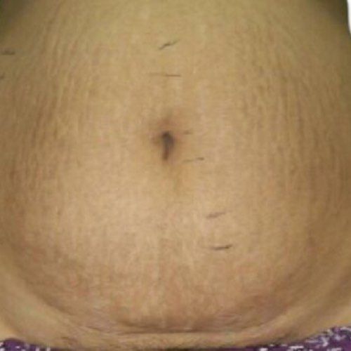 Venus Viva MD stretch marks after treatment