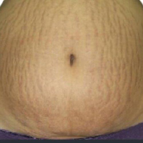 Venus Viva MD stretch marks before treatment