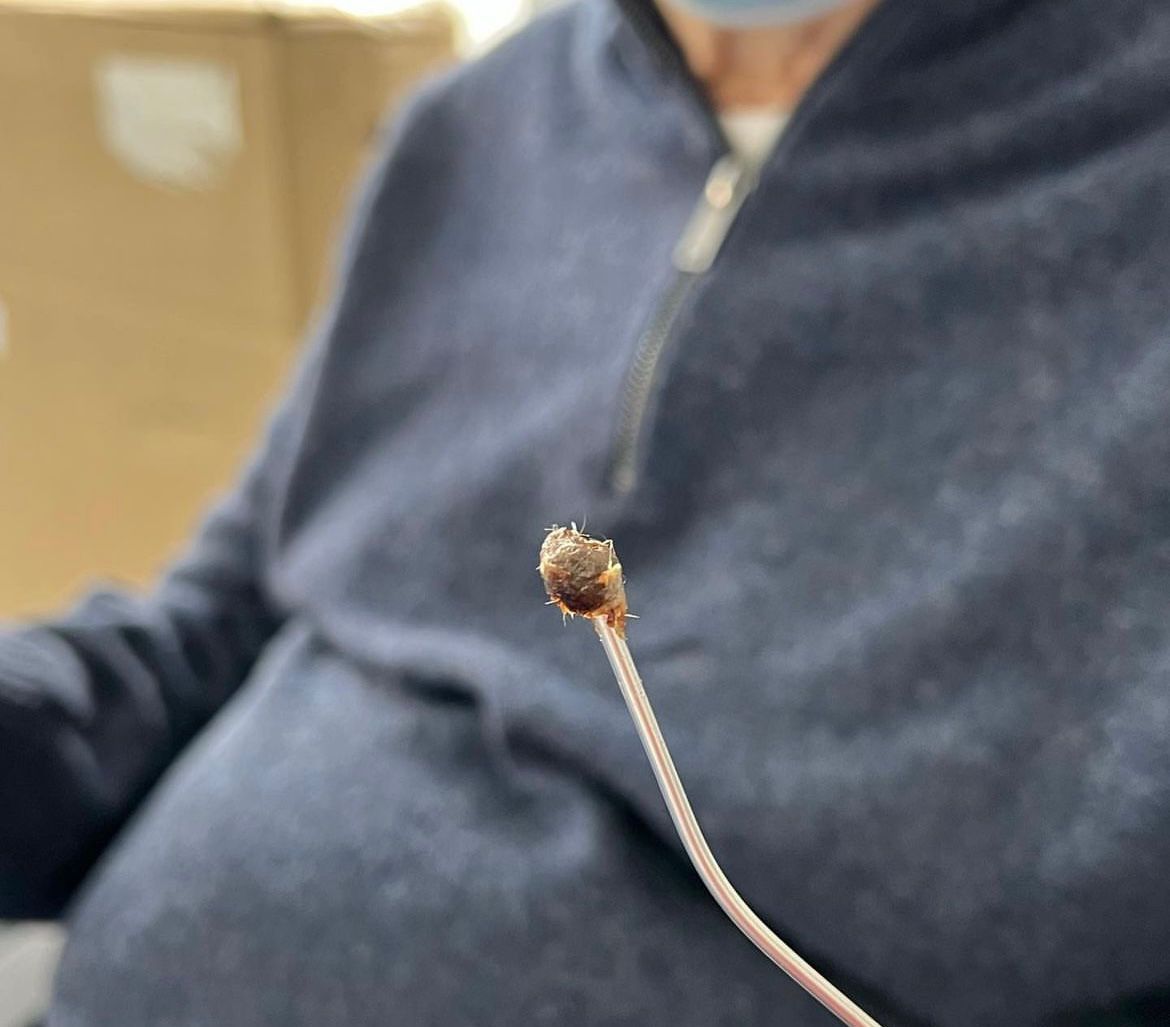 Ear Wax Removal Ealing, London Ealing Hearing Centre