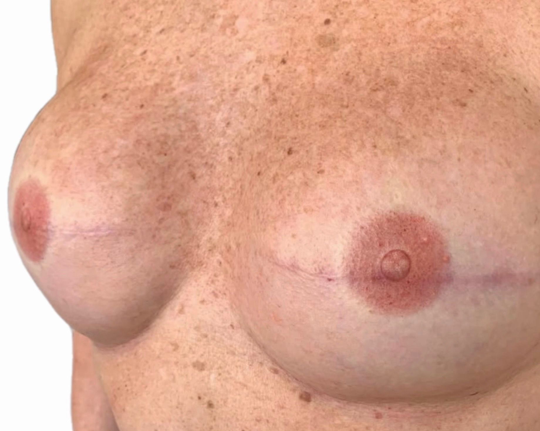 Areola Nipple Reconstruction