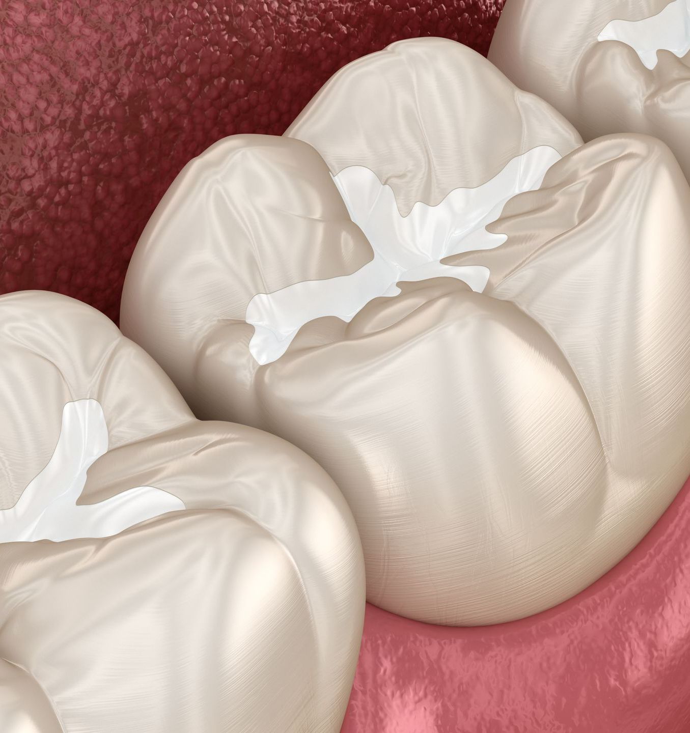 Dental Sealants
