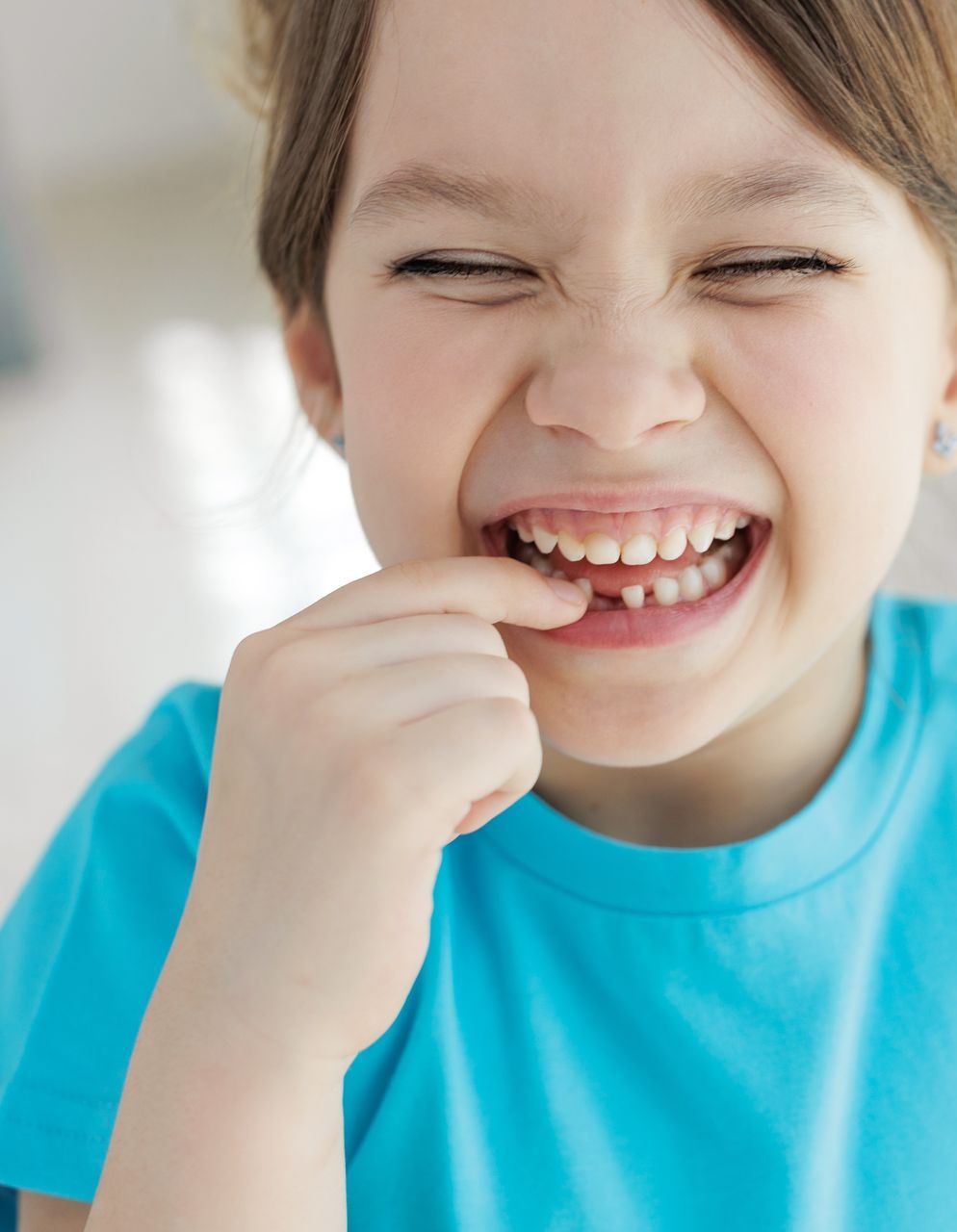 Dental Bridges