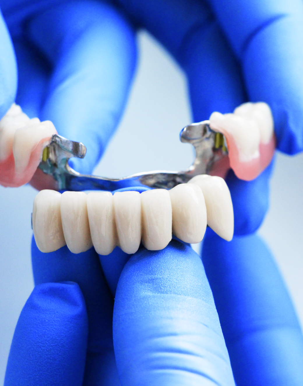 Dental Bridges