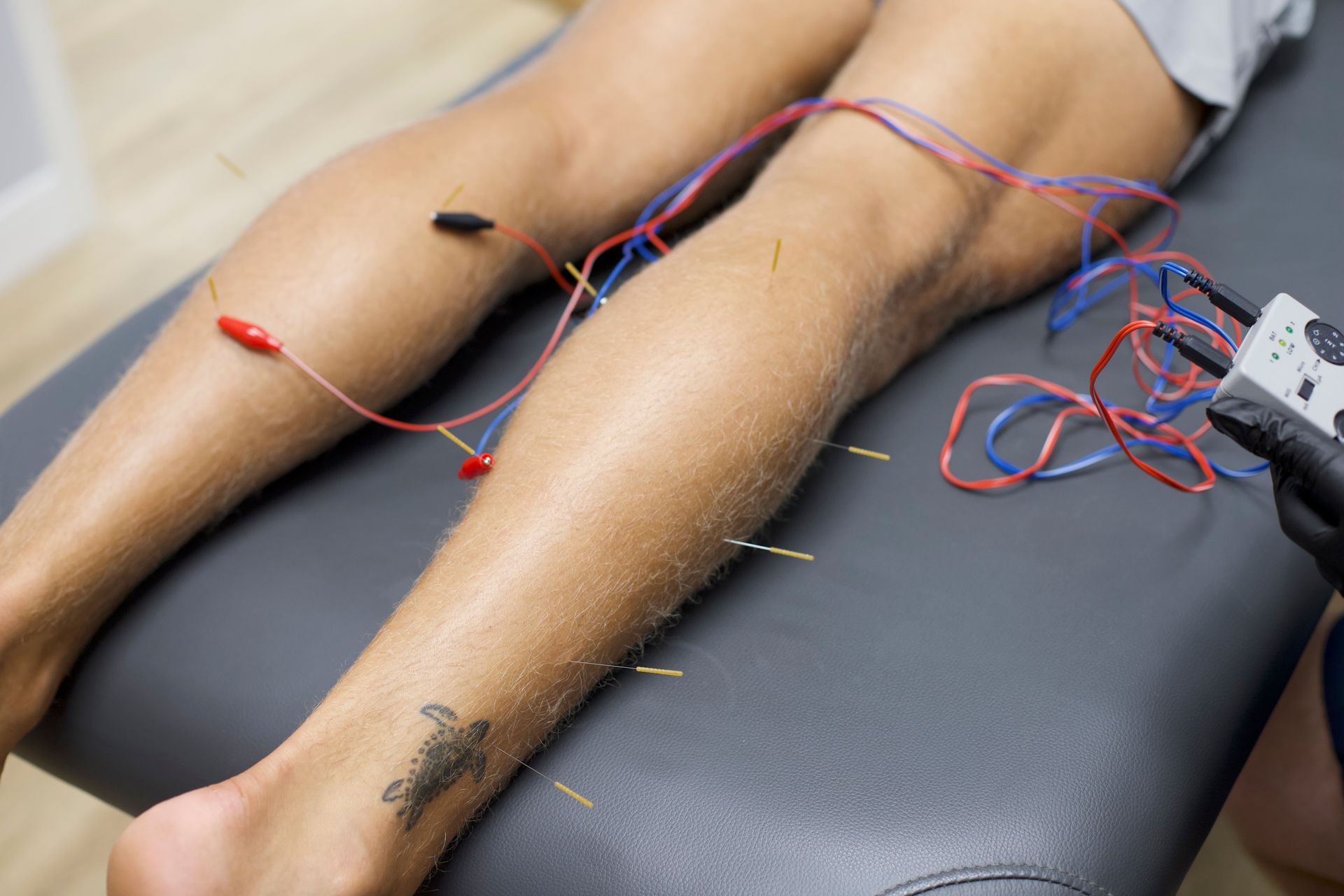 Dry Needling Ponte Vedra, FL | Movement Driven