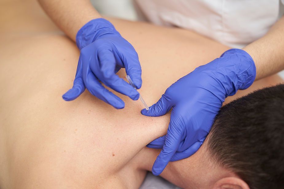 A man is getting an acupuncture treatment on his back. A man is getting an acupuncture treatment on his back.