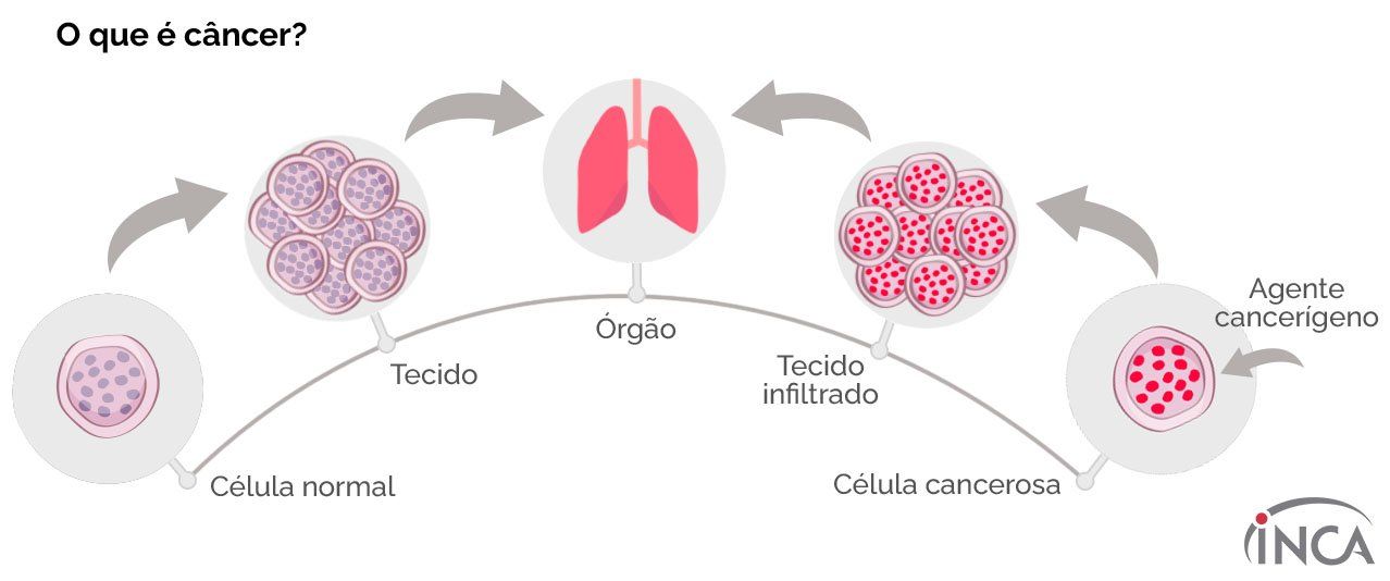 infografico sobre cancer de mama 