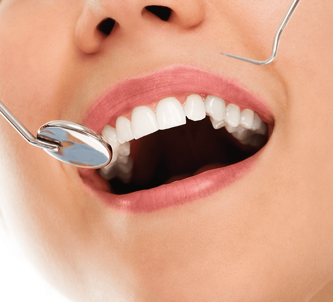 Close-up da boca de uma pessoa sorrindo durante uma consulta odontológica, com um espelho dental refletindo os dentes.