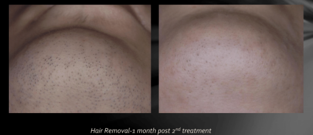 Side-by-side close-up of a freckled cheek before and after skin treatment, showing reduced dark spots.