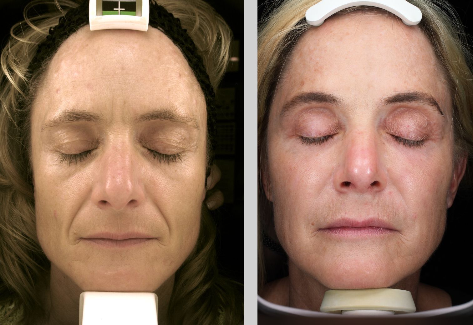A before and after photo of a woman 's face with her eyes closed.