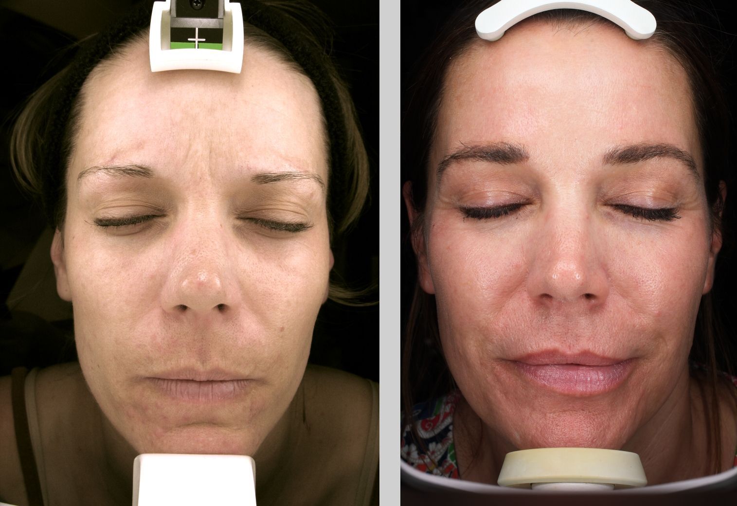 A before and after photo of a woman 's face.