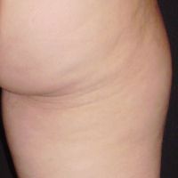 skin 1