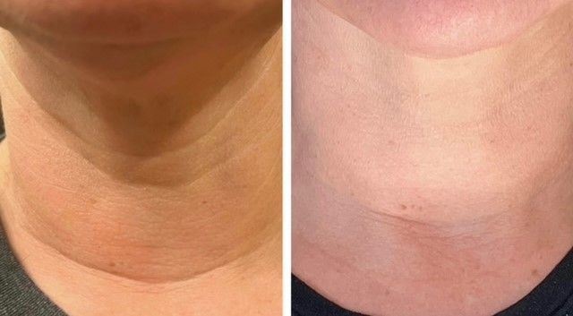 A before and after photo of a woman 's neck and neckline.