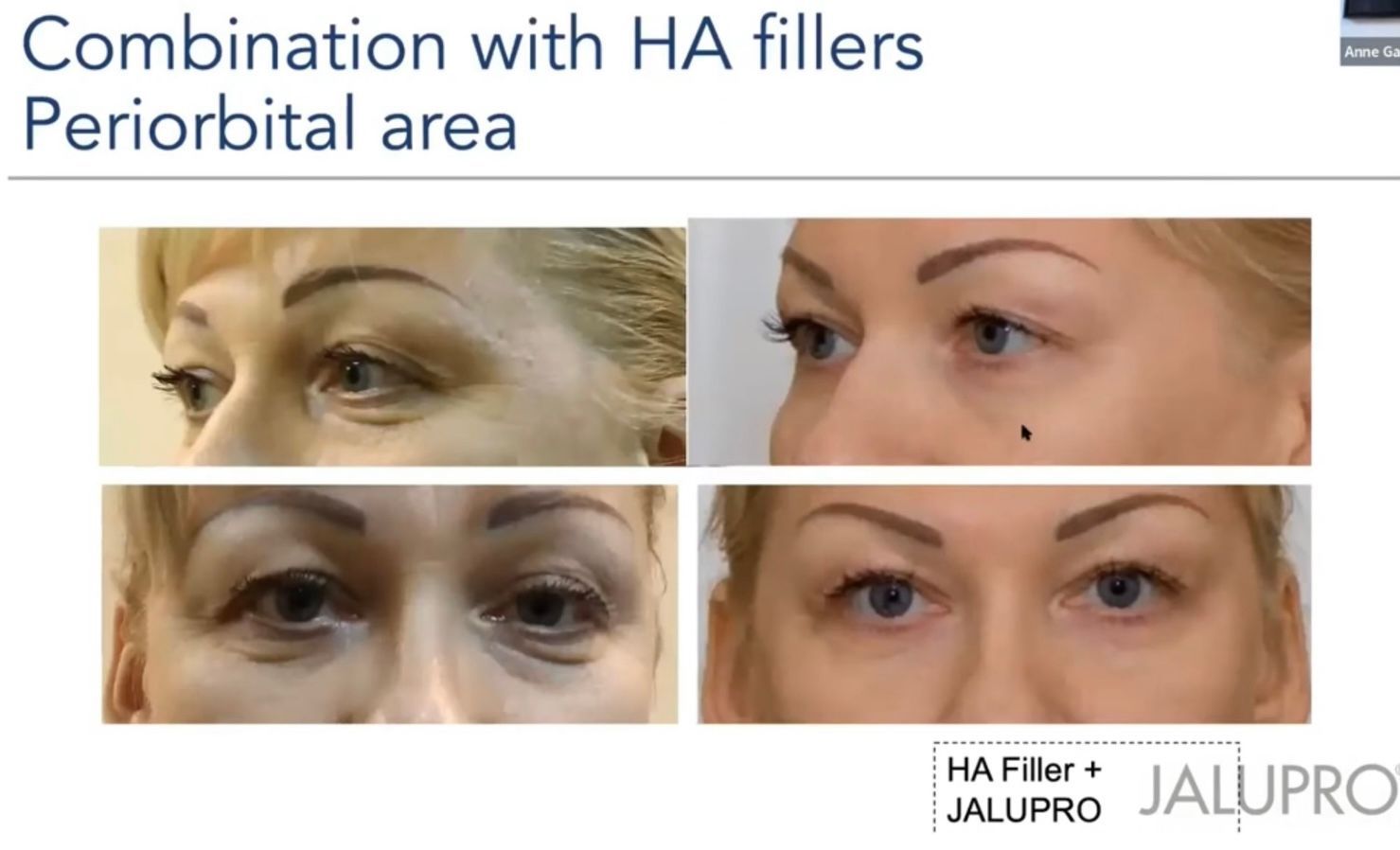 A woman 's face is shown before and after a combination of ha fillers in the periorbital area.