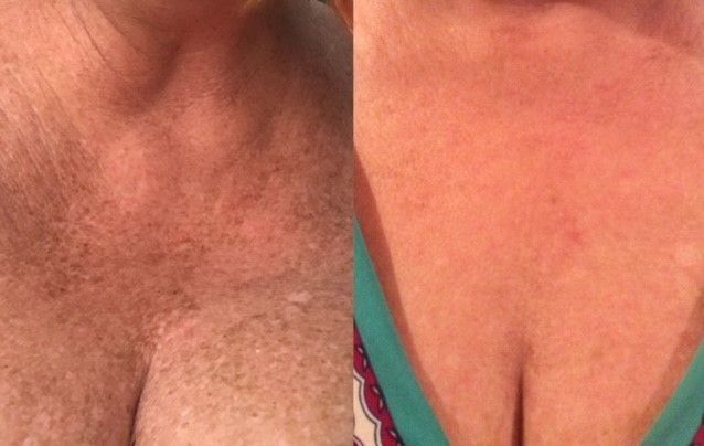 A before and after photo of a woman 's chest and neck.