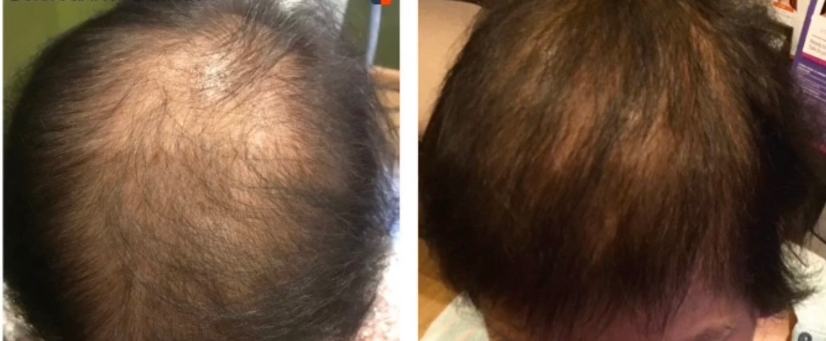 A before and after photo of a person 's hair growth.