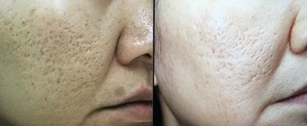 A before and after photo of a woman 's face with freckles.