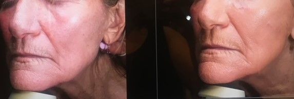 A woman 's face is shown in a before and after photo.