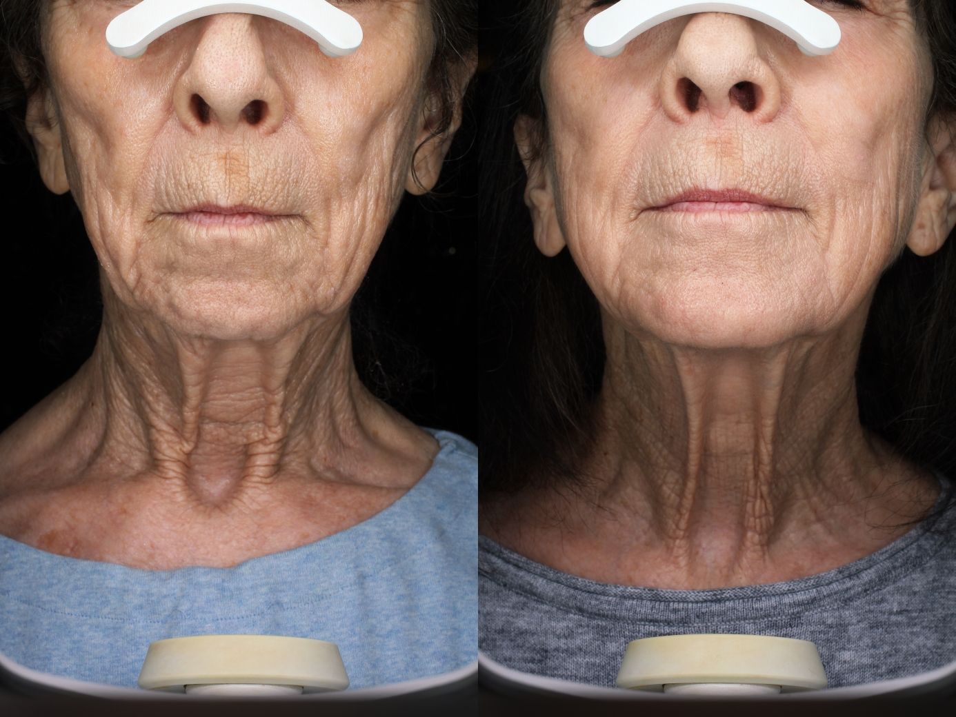 A before and after photo of a woman 's neck and face.