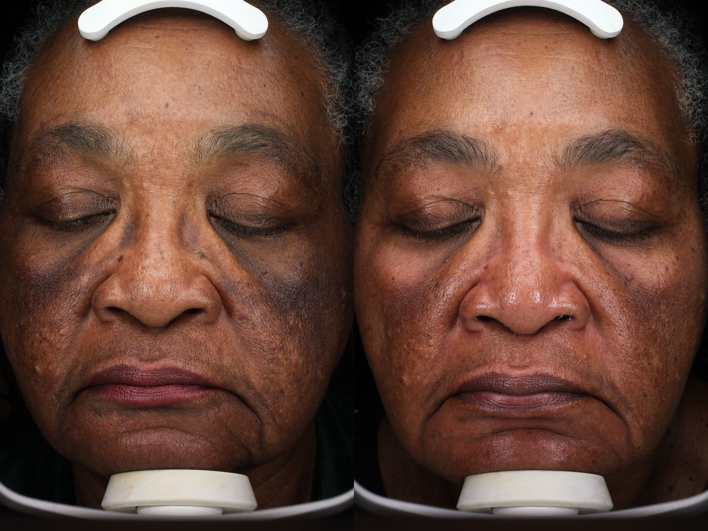 A before and after photo of a woman 's face