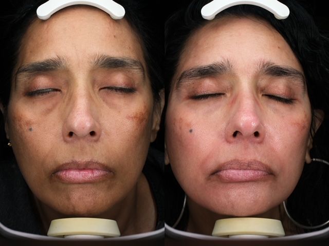A before and after photo of a woman 's face