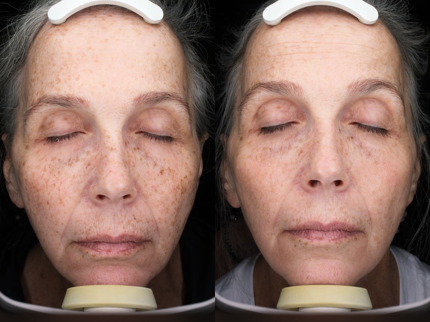 A before and after photo of a woman 's face with her eyes closed.