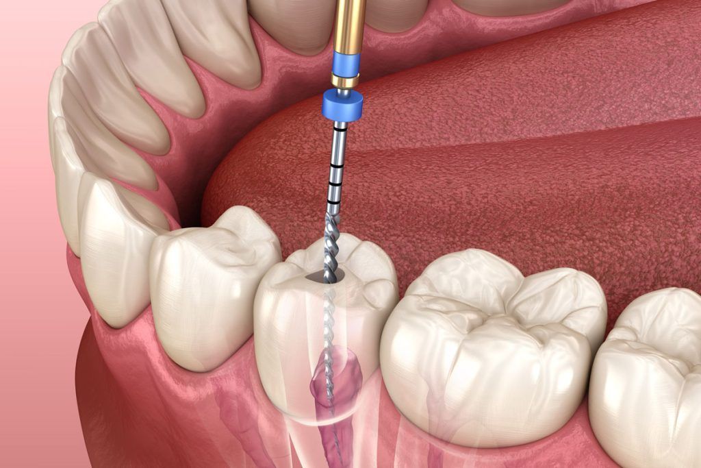 endodonzia
