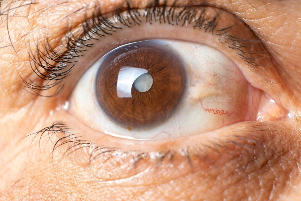 Close-up of a brown eye with visible redness and wrinkles around the skin
