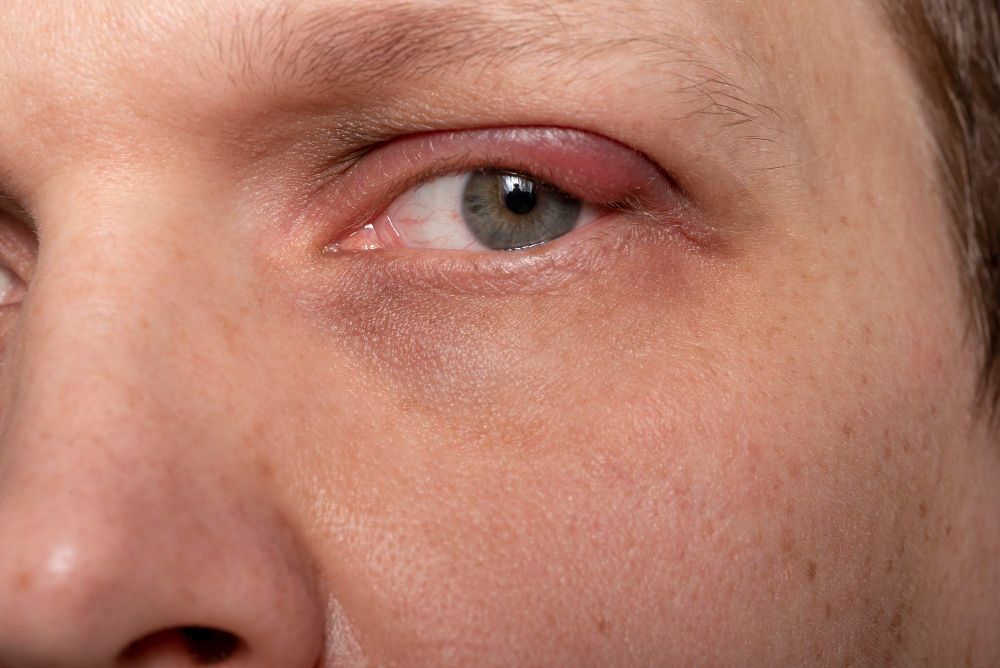 Close-up of a red, swollen eyelid on a person’s face