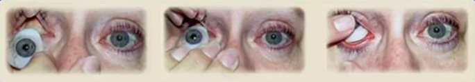 Removing Without A Suction Cup — Cox Ocular Prosthetics, Inc. — Birmingham, AL Removing Without A Suction Cup — Cox Ocular Prosthetics, Inc. — Birmingham, AL